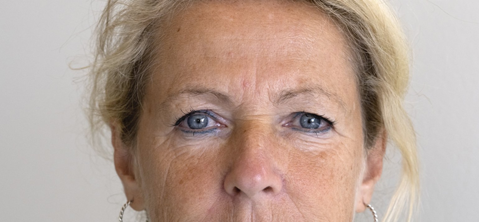 Microneedling en mesopeel tegen pigment vlekken in het gezicht 
